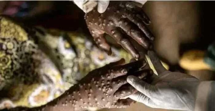 Angola regista 13 novos casos de mpox e mantém 110 doentes activos